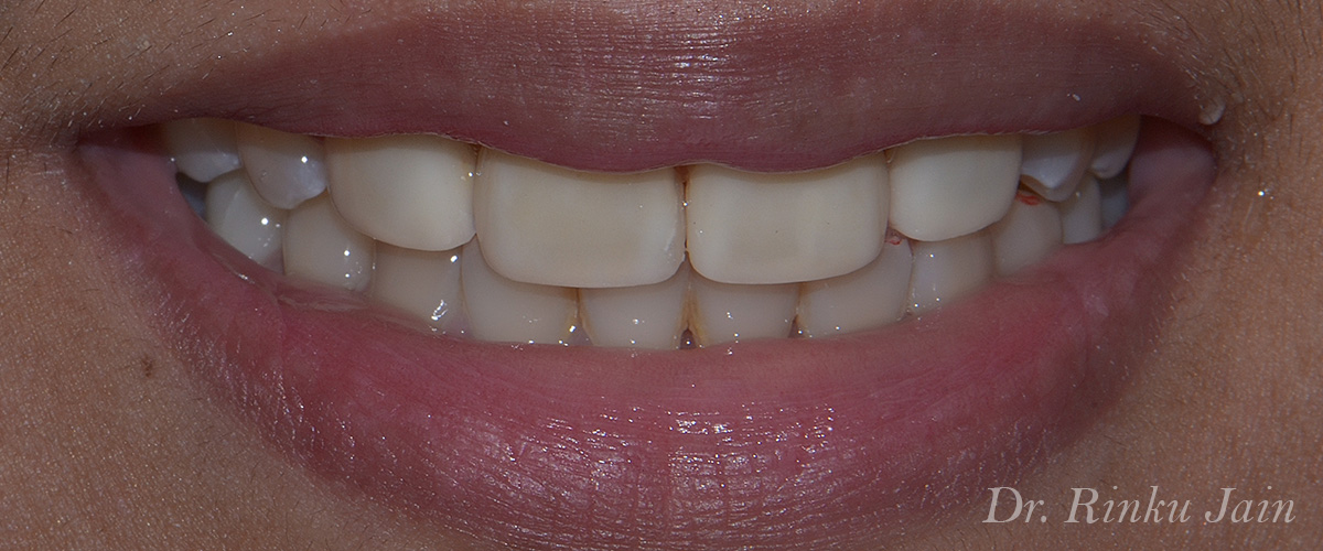 Smile designing biom