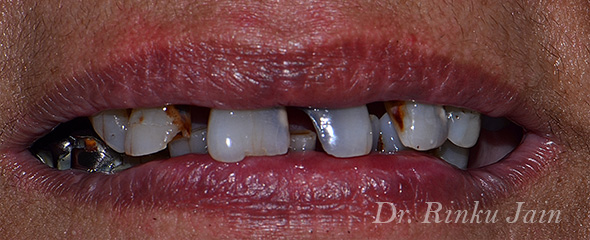 badly decayed teeth