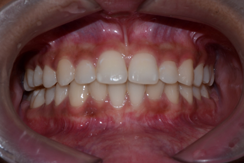 full mouth restoration after