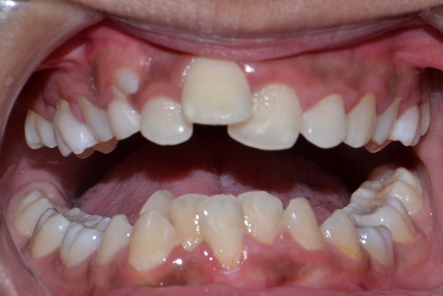 Cavities and broken teeth before