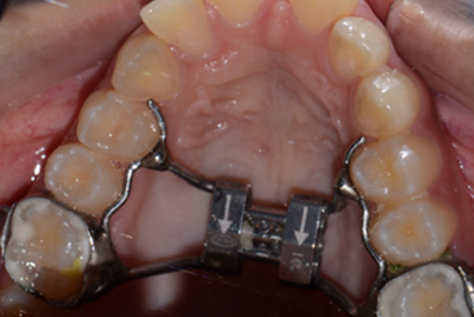 full mouth restoration after