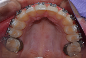 full mouth restoration after