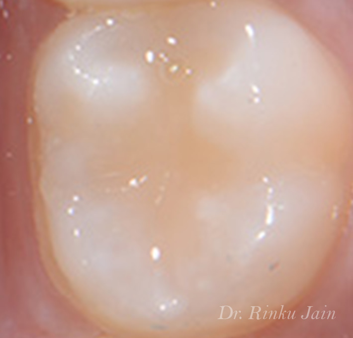 Cavity treated with biom