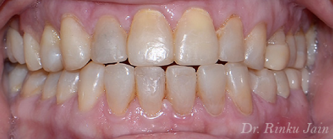 full mouth restoration after