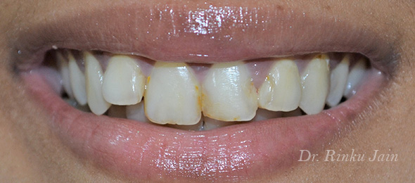 Badly decayed teeth