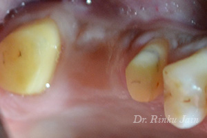 Dental Implants Before