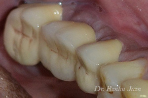 Dental Implants After