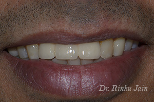 Dental Implants After