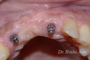 Dental Implants Before