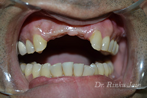 Dental Implants Before