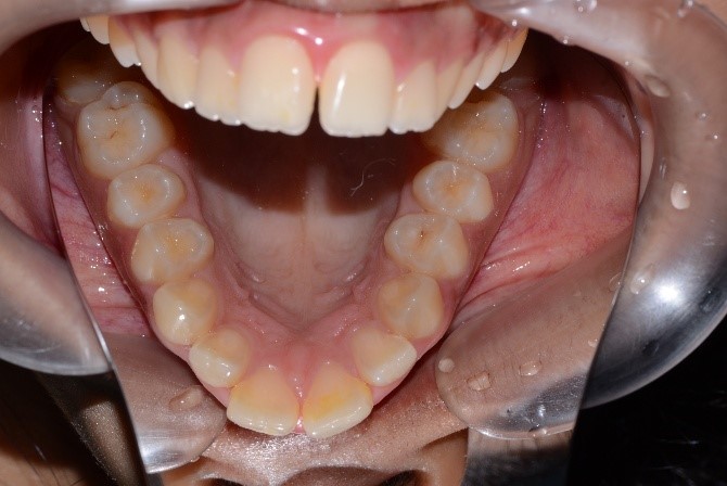Cavities and broken teeth before