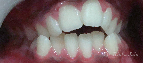 Orthodontic Treatment Before