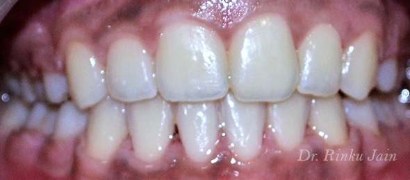 Orthodontic Treatment After