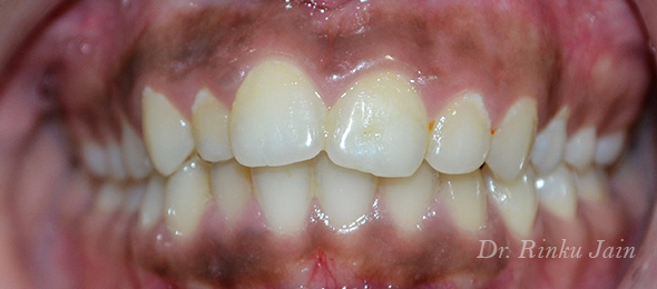 Orthodontic Treatment Before