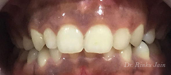 Orthodontic Treatment After