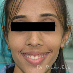 Orthodontic Treatment After