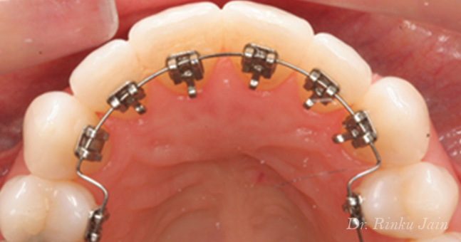 Lingual Orthodontics