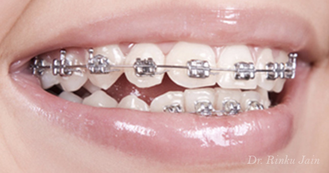 Metal Braces