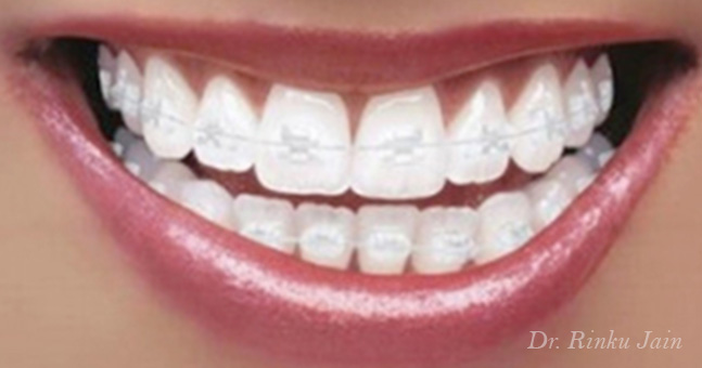 Ceramic Braces