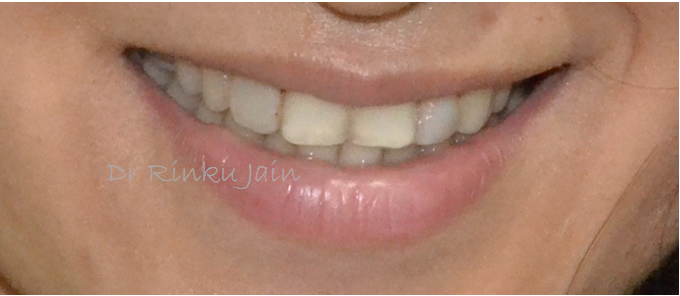 Dental Veneers Before