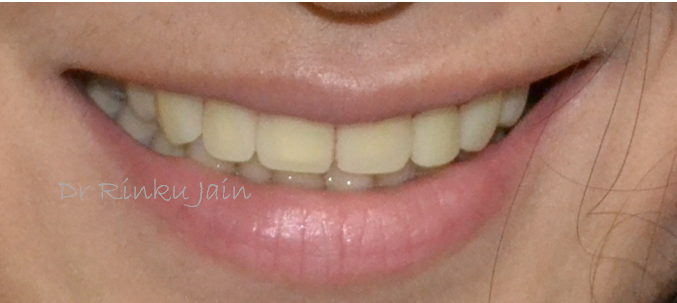 Dental Veneers After